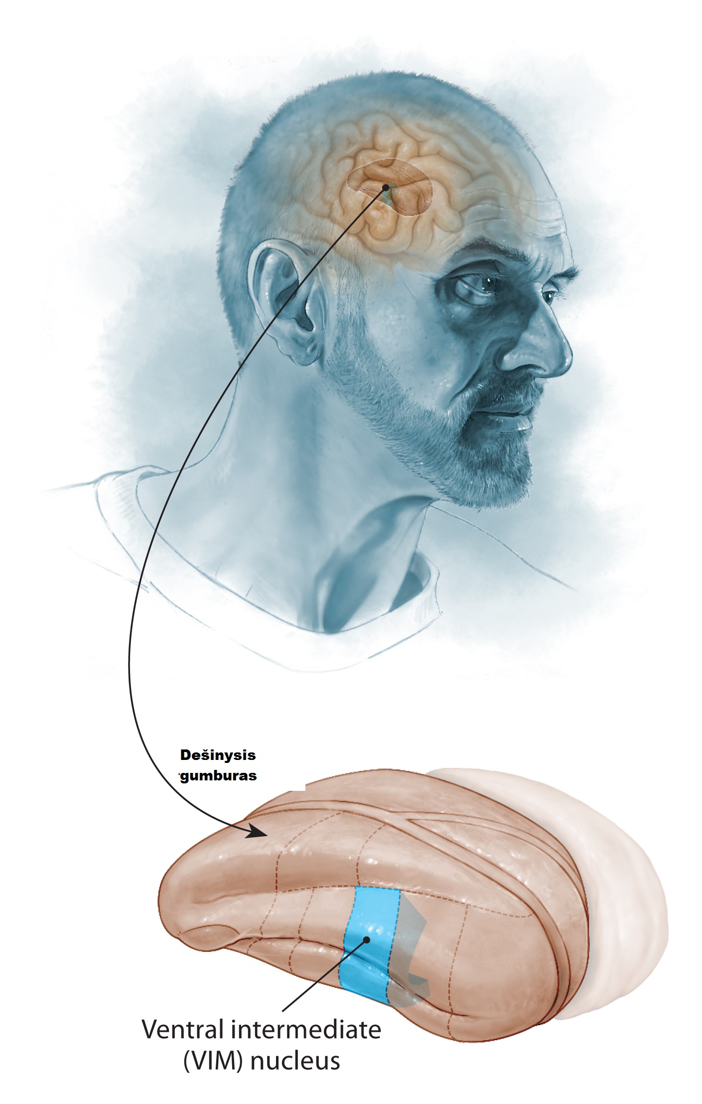 Тремор головы. Постуральный тремор. Essential Tremor. Изометрический тремор.